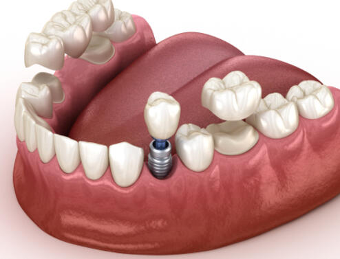 Коронка или имплант: что лучше выбрать?