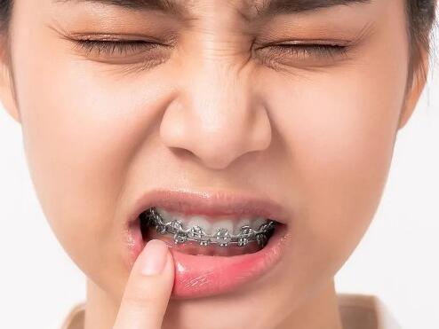 Почему могут болеть зубы в брекетах?