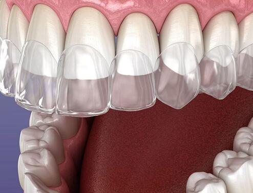Рекомендации при исправлении прикуса элайнерами
