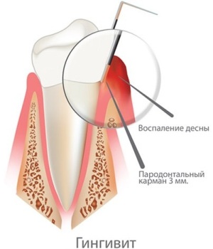 Lechenie Gingivita U Vzroslyh I Detej V Stomatologii Dentko V Minske