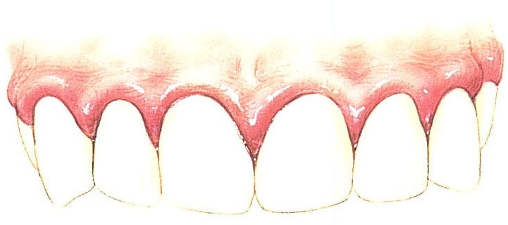 Lechenie Gingivita U Vzroslyh I Detej V Stomatologii Dentko V Minske