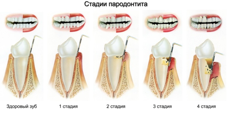 Пародонтит. Способы лечения пародонтита