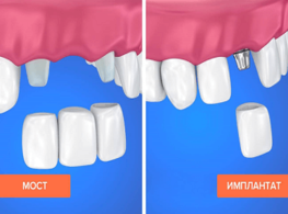 Чем отличается протезирование от имплантации зубов