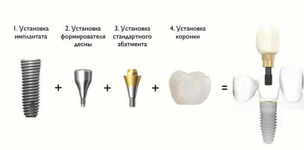              II  IMPLANT-INCOM    