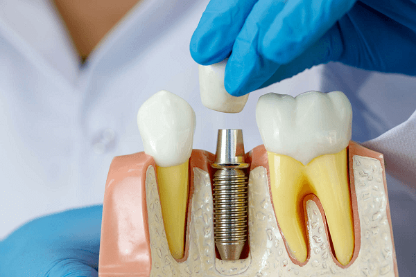 Имплантация 1 зуба: стоимость работы, методы установки