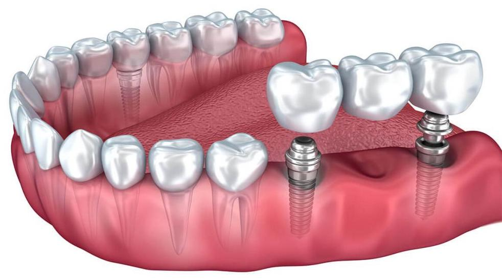 Зубной мост на импланты Беларусь